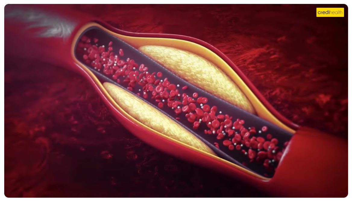 How To Check Heart Blockage At Home